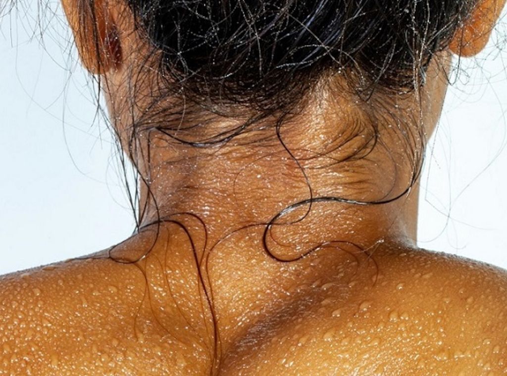 Trockene oder dehydrierte Haut – Was ist der Unterschied?