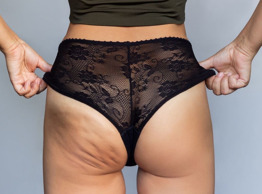 Lipödem oder Cellulite – worin unterscheiden sie sich?
