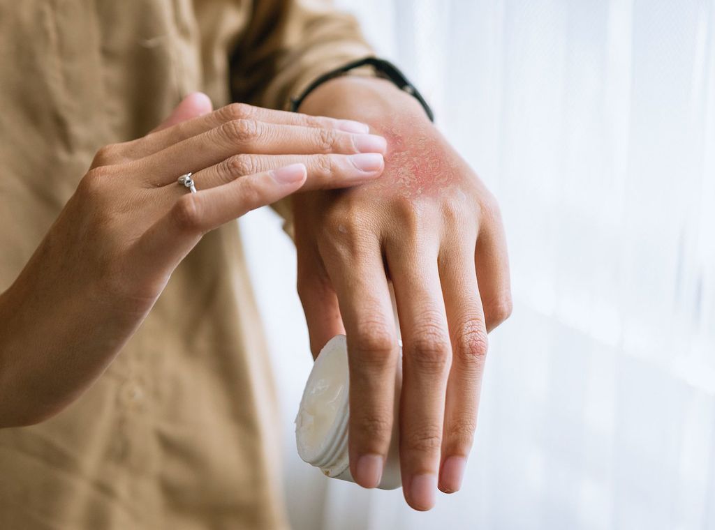myrto Naturkosmetik - Effektive Hautpflege bei Neurodermitis
