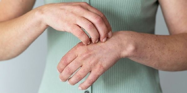 myrto Naturkosmetik - Psoriasis bzw. Schuppenflechte verstehen und lindern