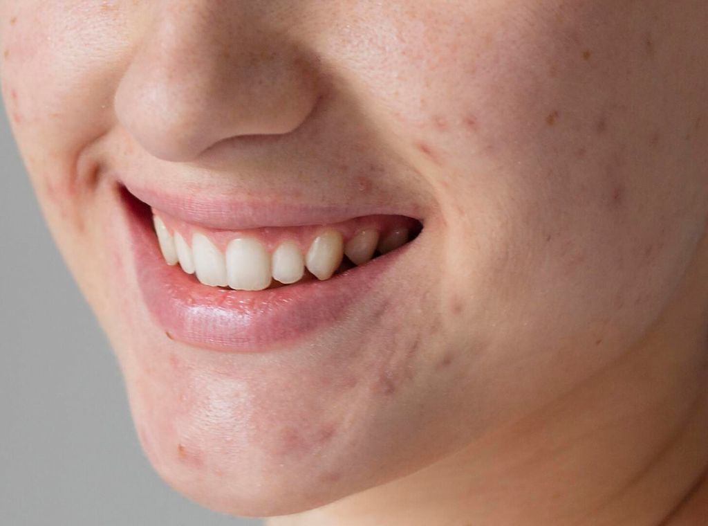 Myrto Naturkosmetik - Was hilft bei vergrößerten Hautporen