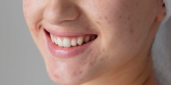 Myrto Naturkosmetik - Was hilft bei vergrößerten Hautporen