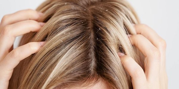 Myrto Naturkosmetik – Juckende Kopfhaut ins Gleichgewicht bringen