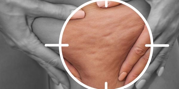 Können Nachfahren von Lipödem-Patientinnen ihre eigene Erkrankung verhindern?