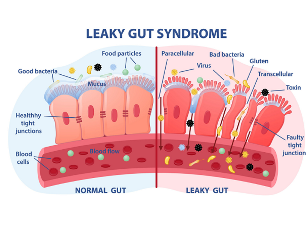 Theorie: Lipödem durch Leaky-Gut-Syndrom begünstigt