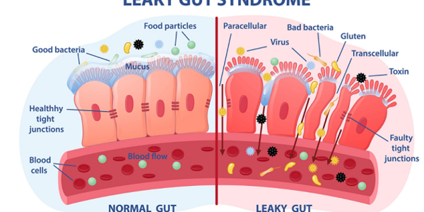 Theorie: Lipödem durch Leaky-Gut-Syndrom begünstigt