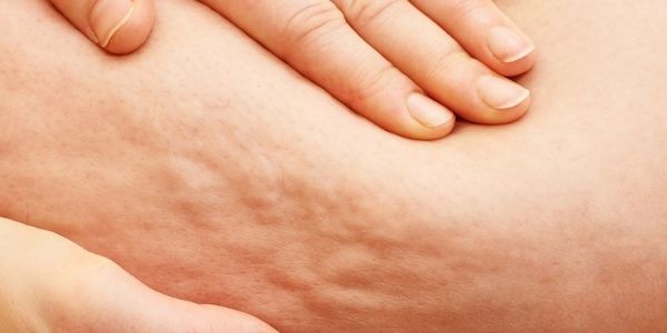 Lipödem: Verschiedene Behandlungen möglich