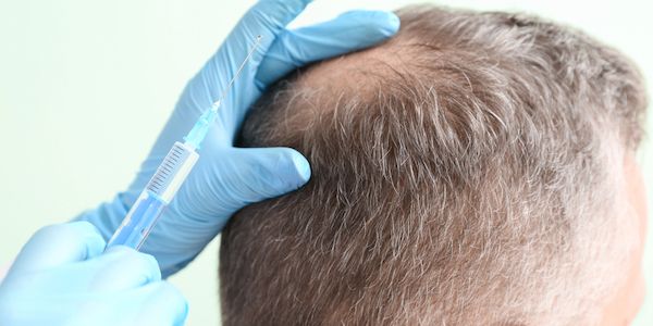 Neues Männerhaar statt Ausfall: Regenerative Therapie aktiviert Wachstum