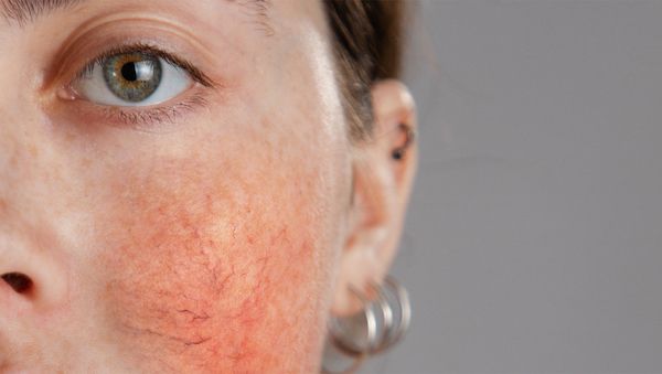 Rosacea und Couperose – Unterschiede und richtige Pflege