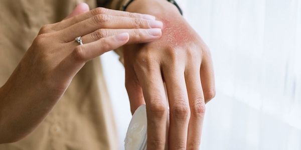 Symptome und Hautveränderungen bei Neurodermitis