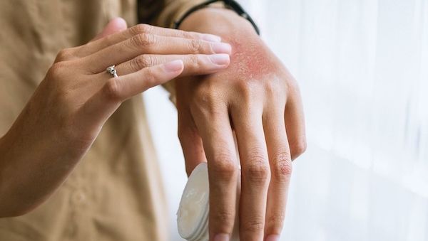 Symptome und Hautveränderungen bei Neurodermitis