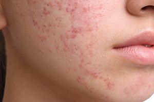 Rosacea oder Akne? – Symptome, Unterschiede & Pflege Bild 1