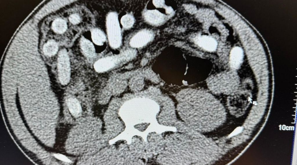 Kölner Zoll stellt Rekordmenge Kokain im Körper eines Italieners sicher