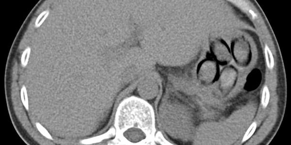 Kölner Zoll stellt Niederländer mit Kokain im Körper