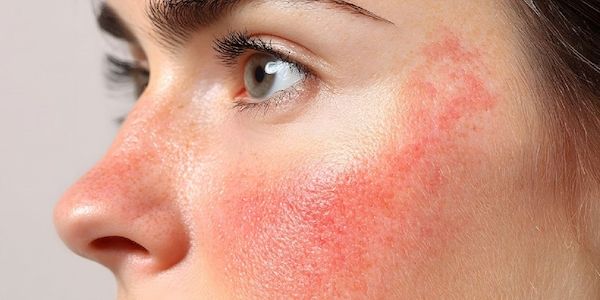 Institut für Naturkosmetik: Über die Symptome und Unterschiede von Rosacea und Akne