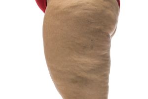 Studienhintergrund: So erreichen Lipödem-Patientinnen mehr Lebensqualität Bild 1