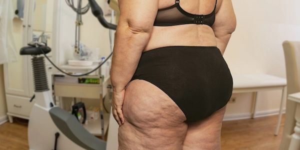 Lipödem: Liposuktion wird jetzt Regelleistung