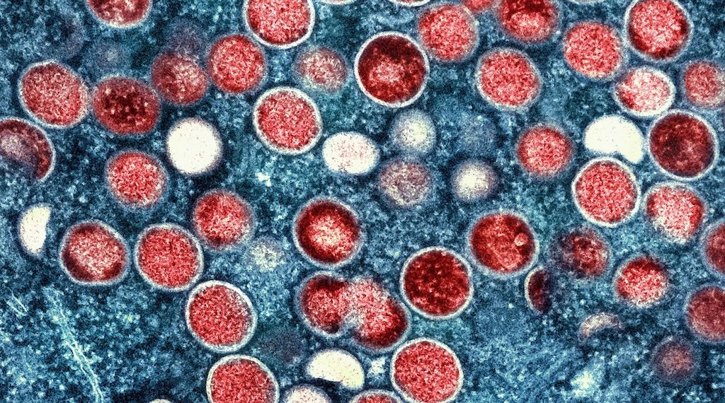 Gesundheitsamt warnt: Mpox-Infektionen jetzt auch in Berlin