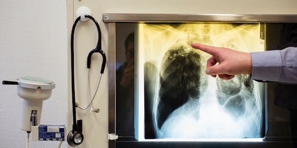 Tuberkulose-Fall in Kita – 130 Menschen müssen zum Bluttest