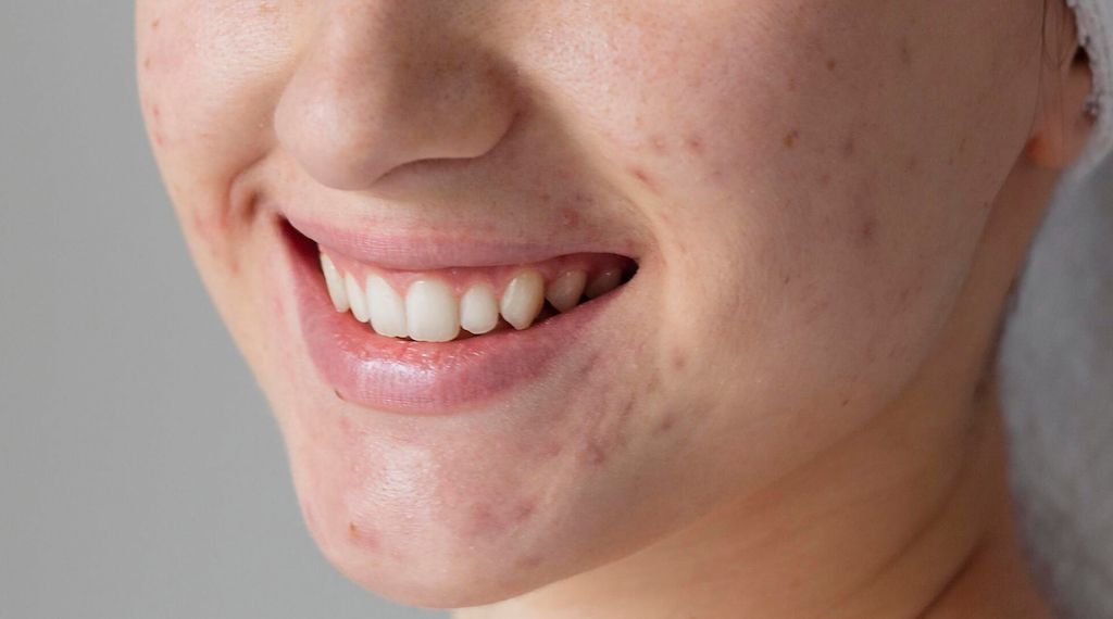 Myrto Naturkosmetik - Was hilft bei vergrößerten Hautporen