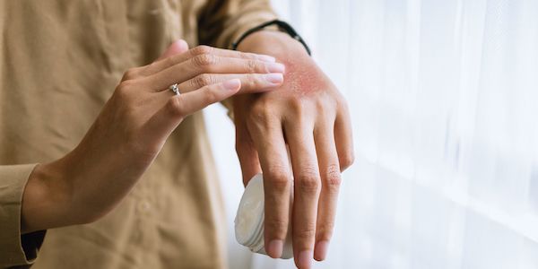 Myrto Naturkosmetik - Neurodermitis verstehen