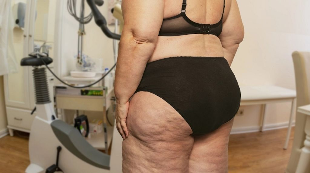 Lipödem: Liposuktion wird jetzt Regelleistung