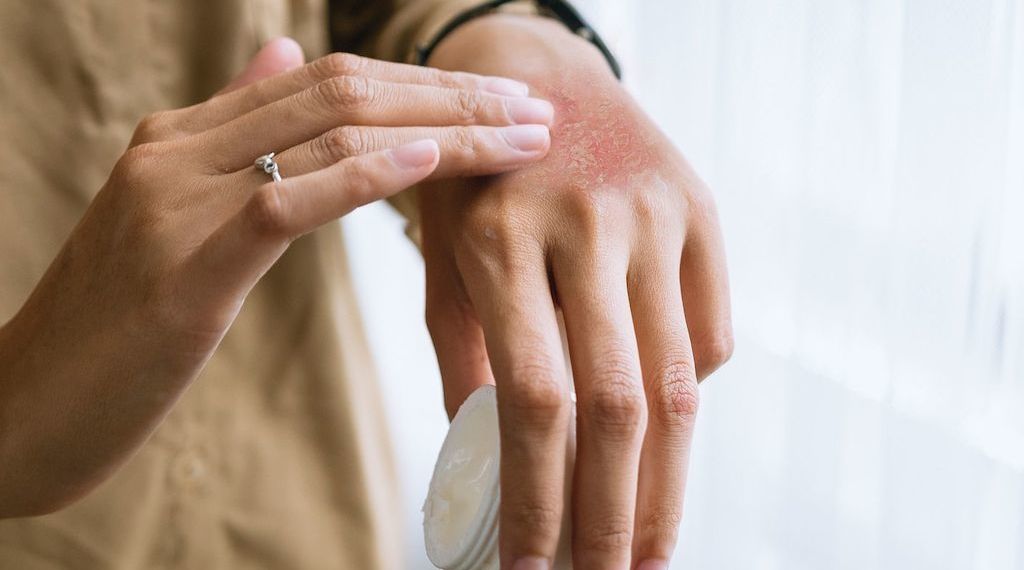 Symptome und Hautveränderungen bei Neurodermitis