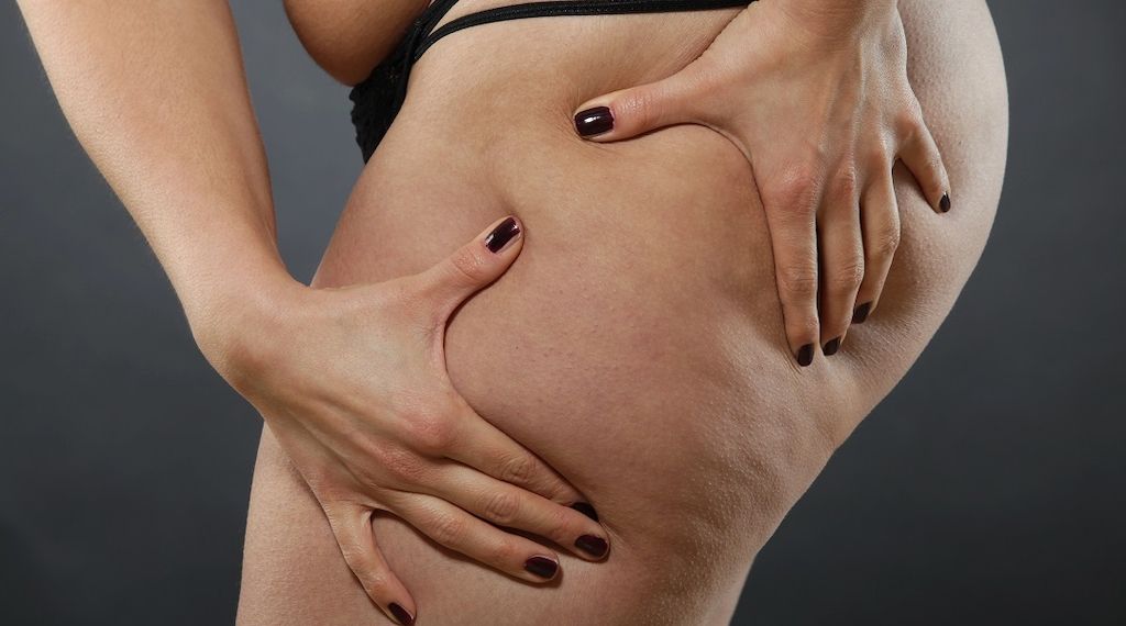 "Ich fühlte mich früher oft alleingelassen" - Erfahrungsbericht einer Lipödem-Patientin