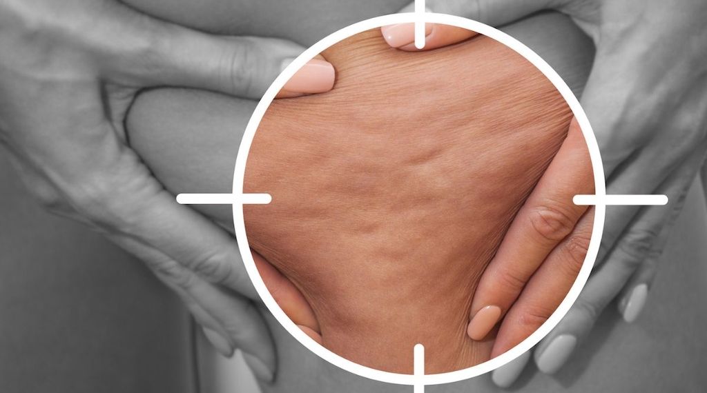 Können Nachfahren von Lipödem-Patientinnen ihre eigene Erkrankung verhindern?