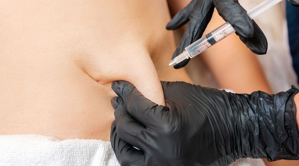 Fett-weg-Spritze: Gefährliche Wunschvorstellung oder berechtigte Hoffnung für Lipödem-Patientinnen? 