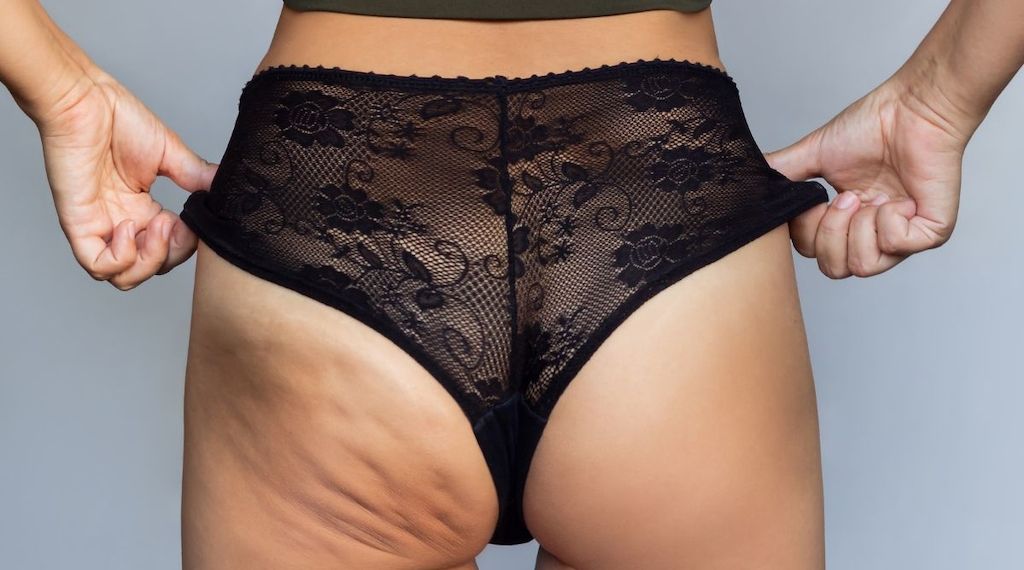 Lipödem oder Cellulite – worin unterscheiden sie sich?