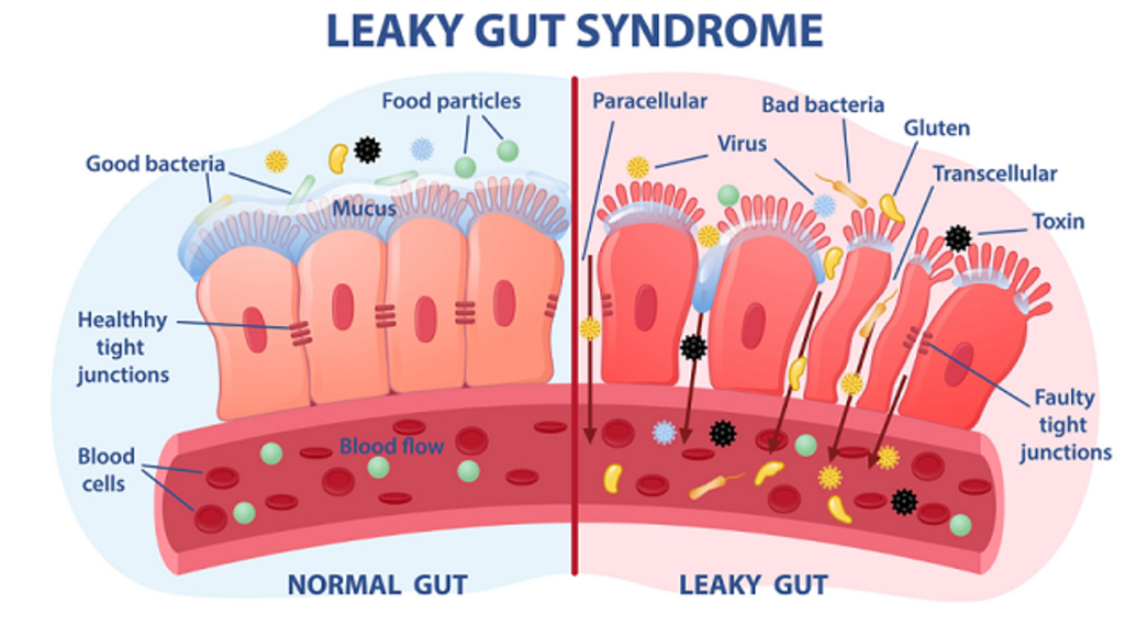 Theorie: Lipödem durch Leaky-Gut-Syndrom begünstigt