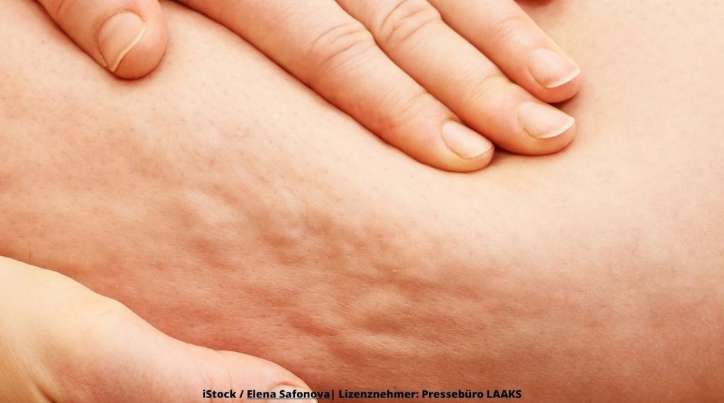 Lipödem: Verschiedene Behandlungen möglich