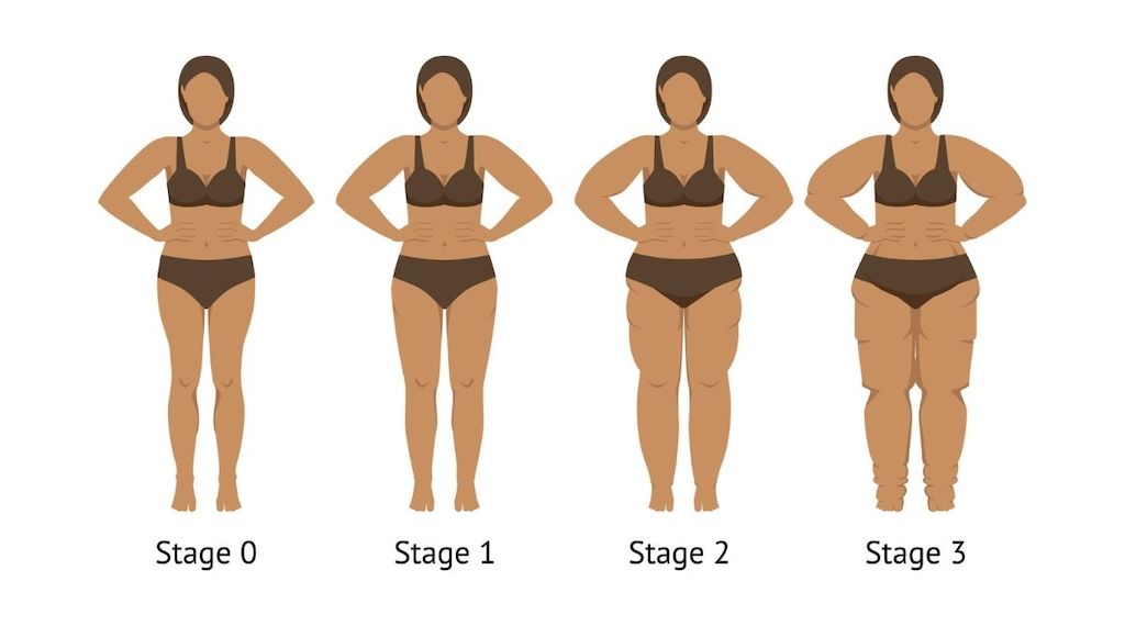 Lipödem: Eine Krankheit – drei Stadien
