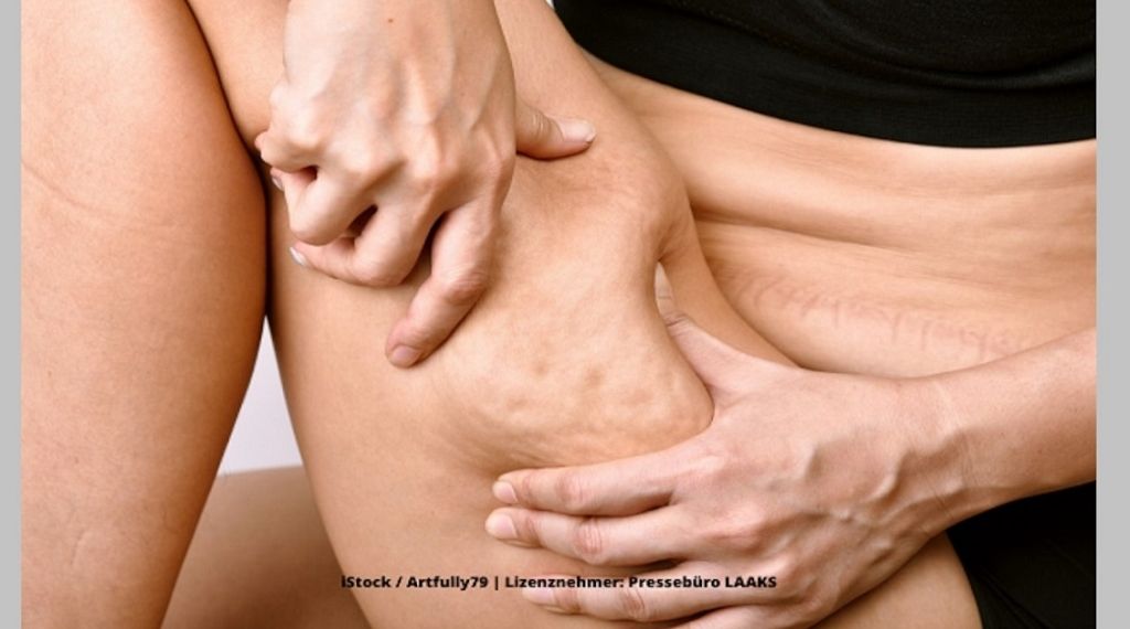 Lipödem: Welches sind die Symptome der versteckten Volkskrankheit?