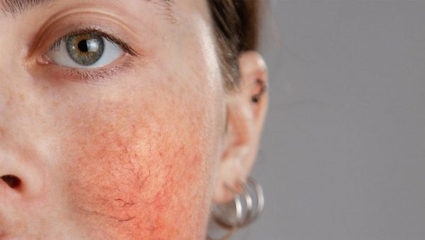 Rosacea und Couperose – Unterschiede und richtige Pflege