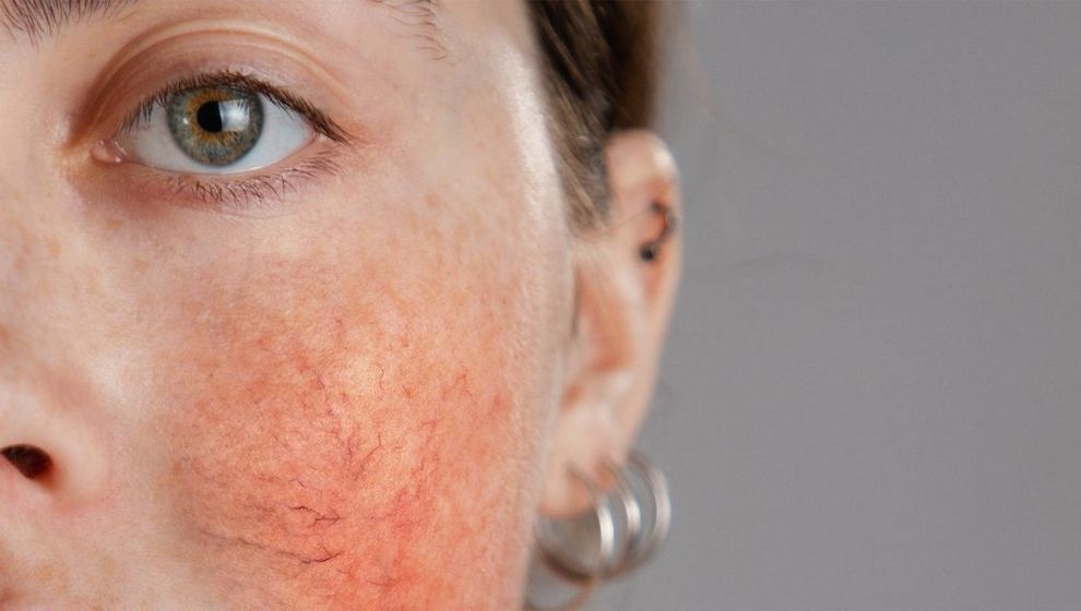 Rosacea und Couperose – Unterschiede und richtige Pflege