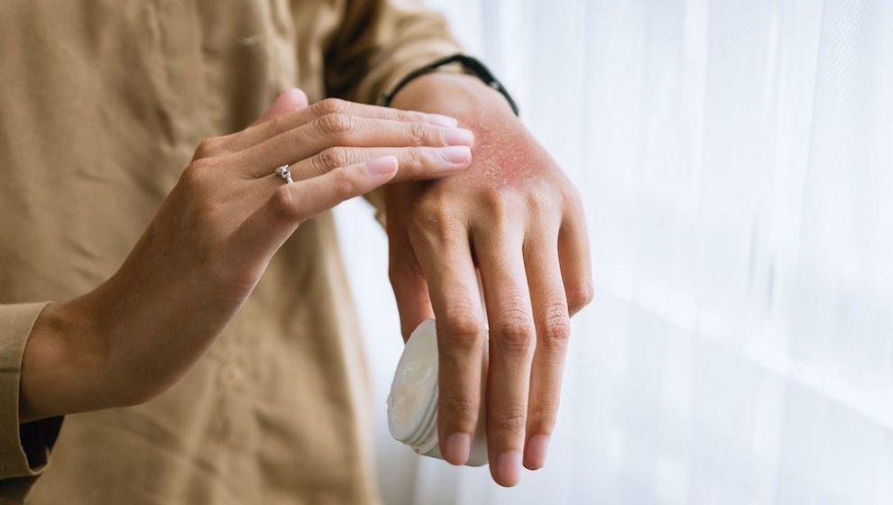 Myrto Naturkosmetik - Neurodermitis verstehen