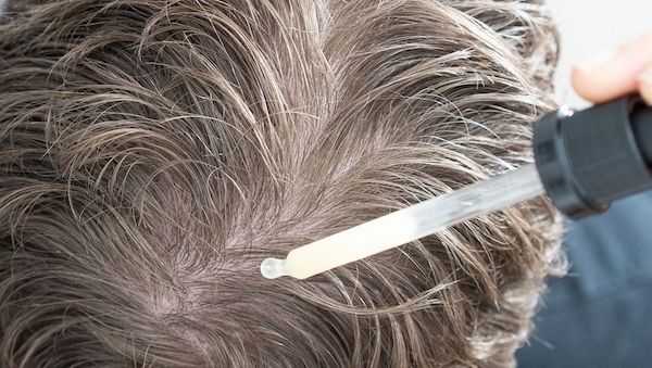 Haarausfall vorbeugen und behandeln