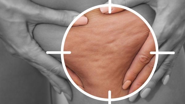 Können Nachfahren von Lipödem-Patientinnen ihre eigene Erkrankung verhindern?