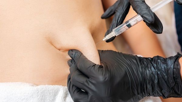 Fett-weg-Spritze: Gefährliche Wunschvorstellung oder berechtigte Hoffnung für Lipödem-Patientinnen? 