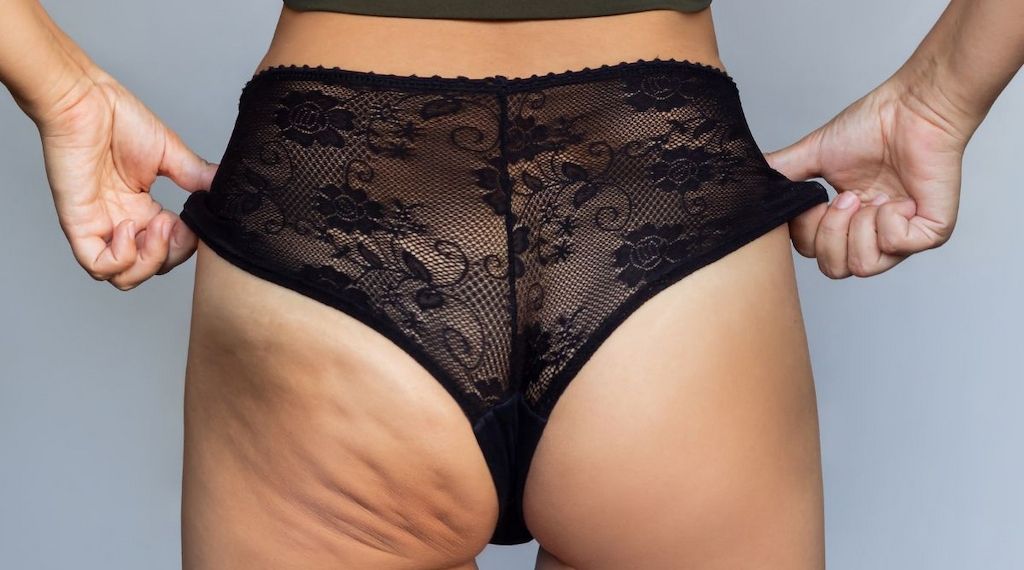 Lipödem oder Cellulite – worin unterscheiden sie sich?